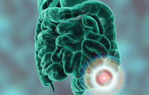 detección precoz cáncer de colon
